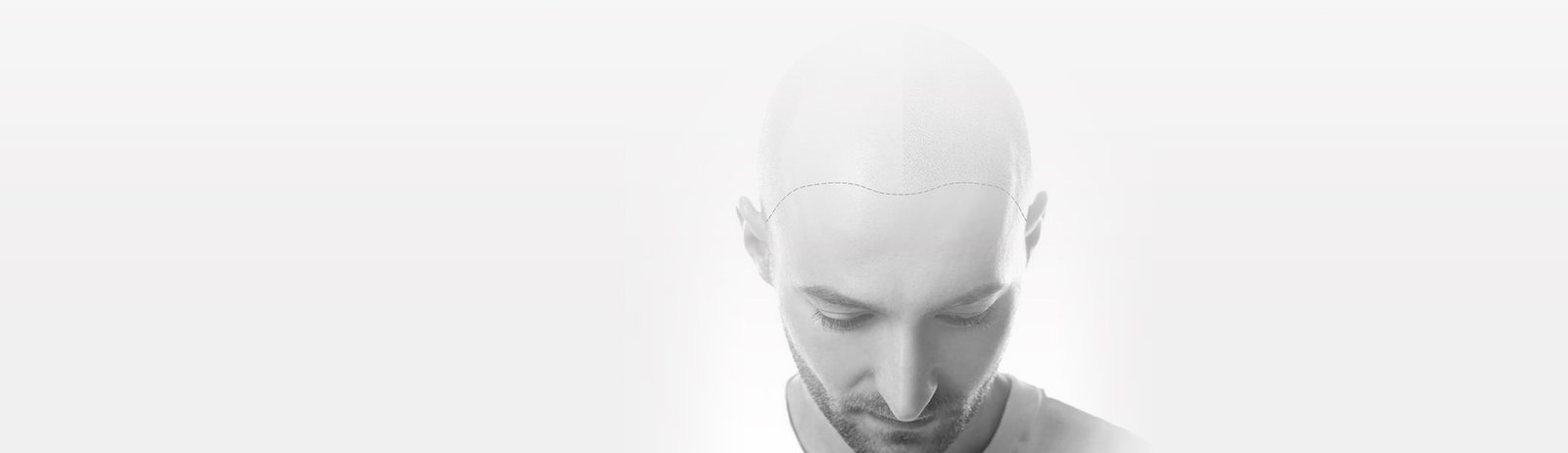 Haartransplantation Behandlung