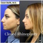 rhinoplasty-5